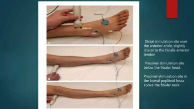 Foot drop | PPTX